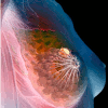 Breast cancer. The yellow mass in the illustration depicts a tumor located in a glandular tissue of the breast.